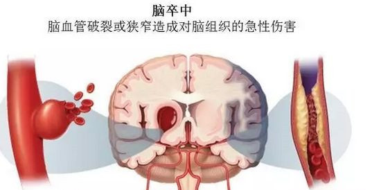 臭氧治疗仪--远离尿酸中风第四高