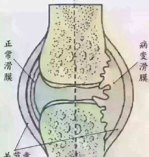 臭氧疗法治疗滑膜炎的原理