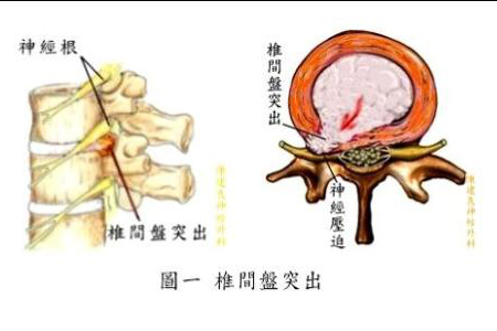 椎间盘突出