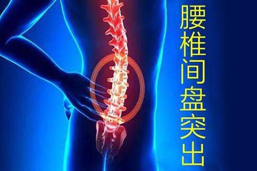 椎间盘突出
