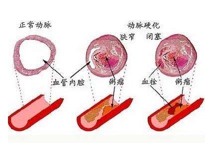 心绞痛、心律不齐、动脉硬化，还不快试试臭氧