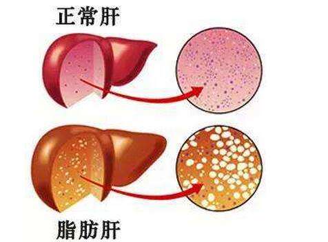 关于臭氧如何治疗肝病
