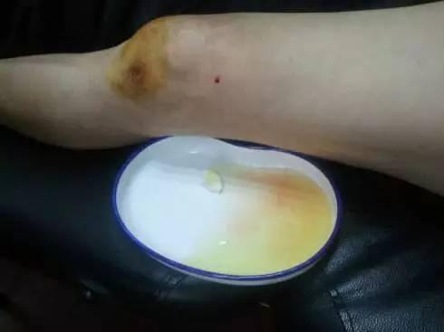膝关节积液、肿胀？医用三氧疗法轻松缓解关节疼痛，腿疼不求人！