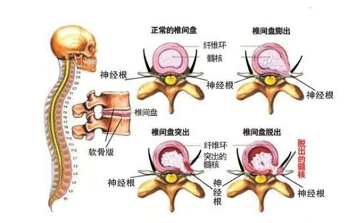 臭氧疗法让你从骨子里突出