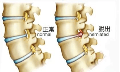 臭氧治疗腰椎间盘突出症
