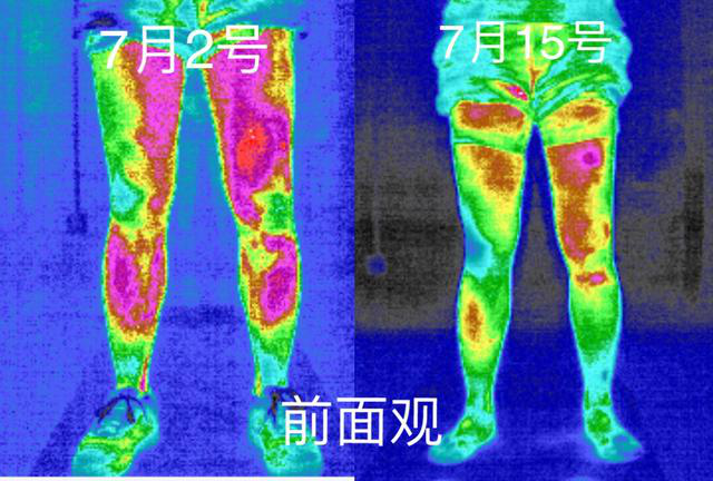 医用红外热成像技术在运动损伤中的应用