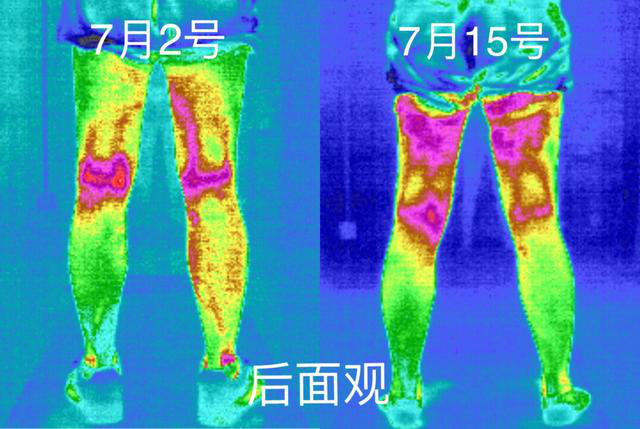 医用红外热成像技术在运动损伤中的应用