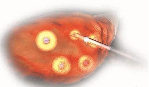 3分钟详解——安通卵泡穿刺针功效