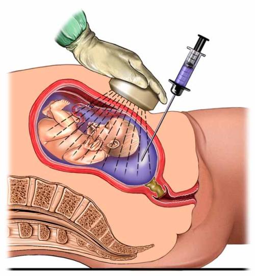做羊水穿刺前你必须知道的7要素