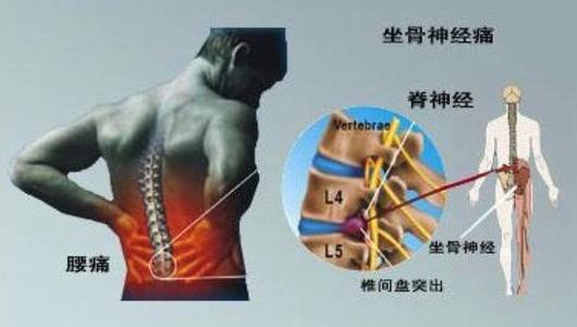 臭氧治疗腰椎间盘突出得注射几次才有效？关键术后做好这3点