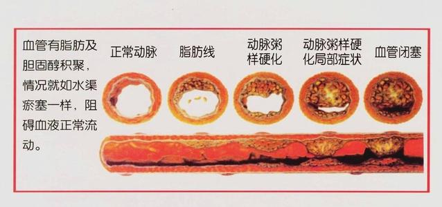 三氧疗法：控制动脉粥样硬化的有效干预措施