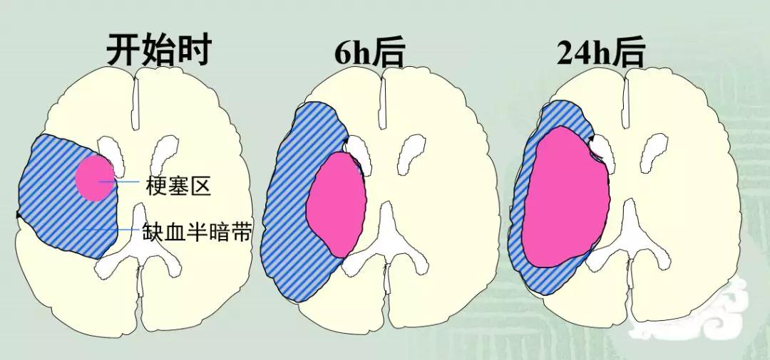 得了脑梗死不妨试试臭氧大自血疗法