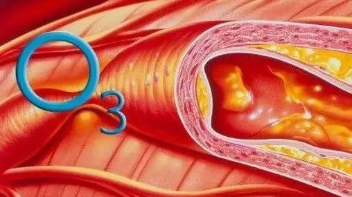 三氧大自血治疗动脉粥样硬化新方法出来了
