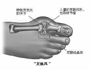 痛风用臭氧大自血疗法有什么好处？