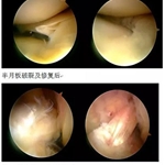 膝关节镜手术的优点： ◆高精确：手术精细，诊