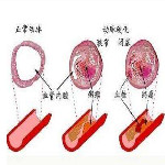 心绞痛、心律不齐、动脉硬化，还不快试试臭氧