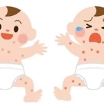 臭氧澡告别湿疹永不复发