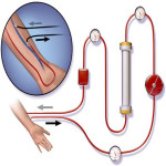 血液透析与自血疗法的区别