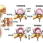 臭氧疗法让你从骨子里突出