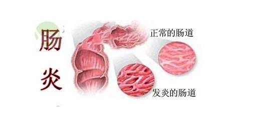 医学的突破！结肠炎患者有救了