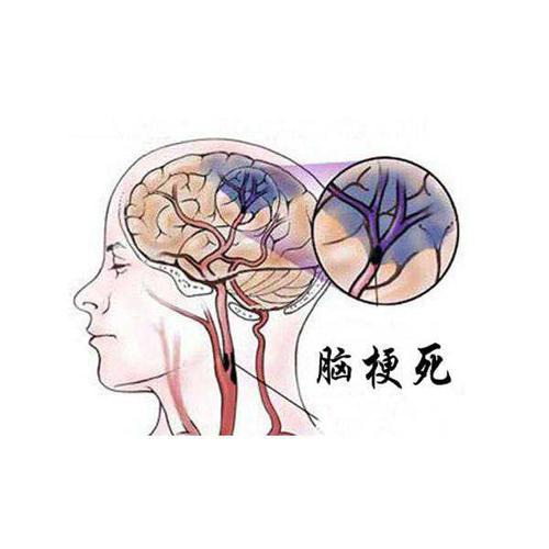 预防脑梗死的新措施——臭氧大自血疗法