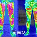 医用红外热成像技术在运动损伤中的应用