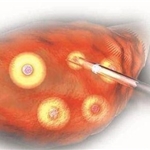 3分钟详解——安通卵泡穿刺针功效