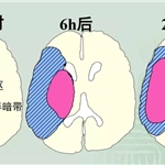 得了脑梗死不妨试试臭氧大自血疗法