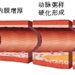 三氧疗法享誉国内外，溶血栓、补充氧、改善功能障碍